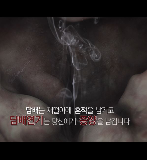 흡연폐해 동영상 : 후두암  게시물의 이미지